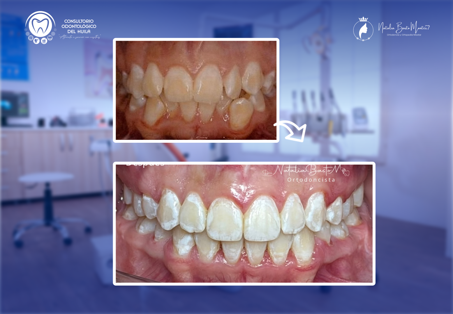 Antes y después de tratamiento de ortodoncia con bracket MBT en paciente adolescente