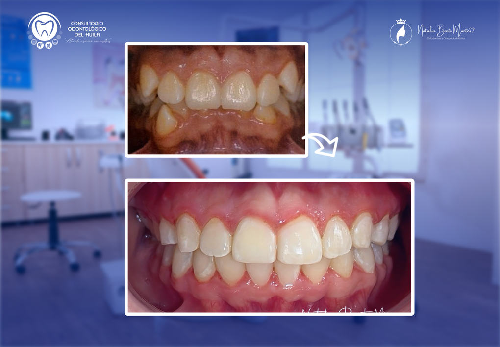 Antes y después de tratamiento de ortodoncia con bracket MBT sin extracciones