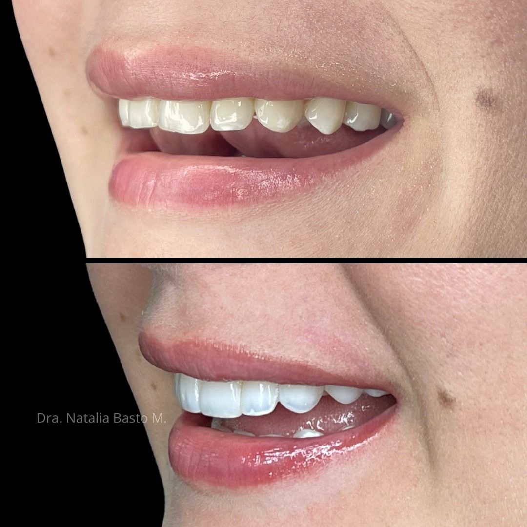 ¡Una sonrisa radiante con resinas de alta estética dental estratificadas!