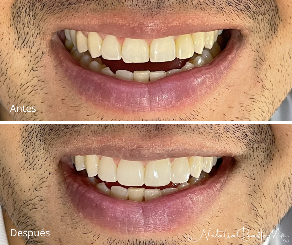 Restauración estética con resina: naturalidad y armonía en la sonrisa
