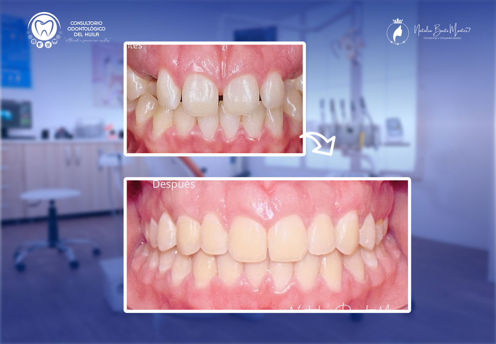Caso de Éxito: Dientes que crecen en armonia con un Diseño de Sonrisa Natural solo con Ortodoncia