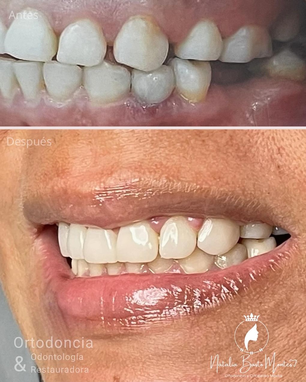 Prótesis dental de alto impacto