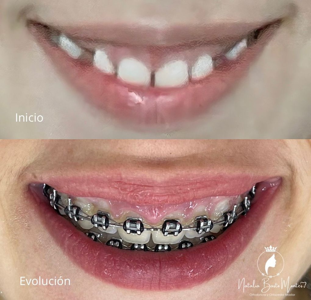 Ortodoncia con Tracción de Caninos Retenidos: Un Caso de Evolución y Progreso