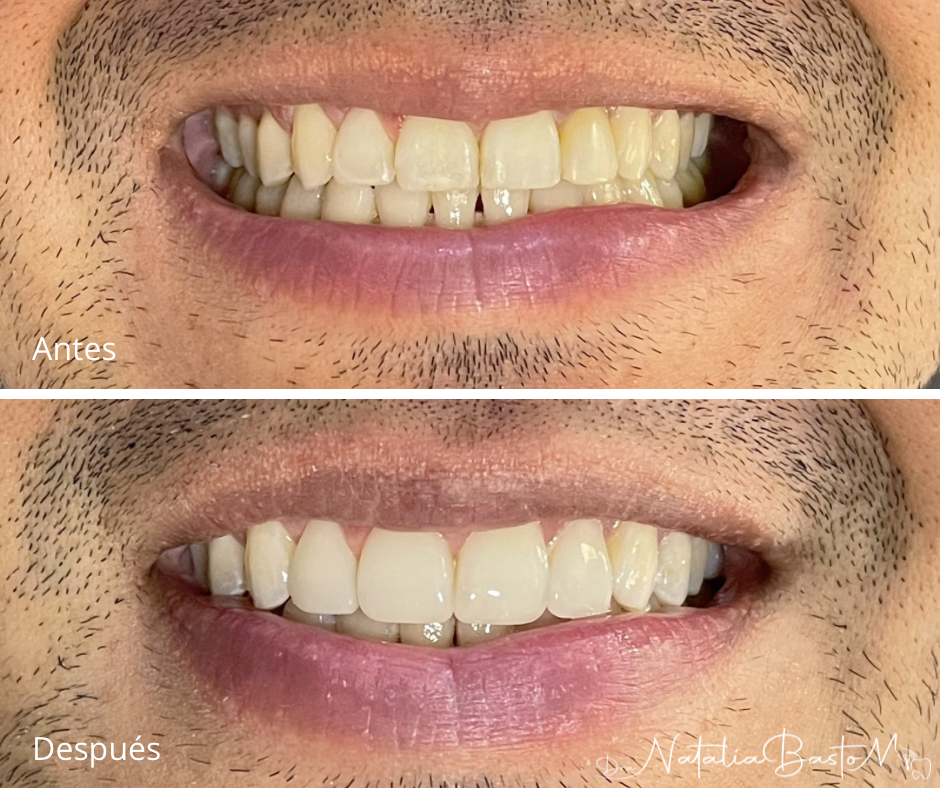 Restauración estética con resina: naturalidad y armonía en la sonrisa