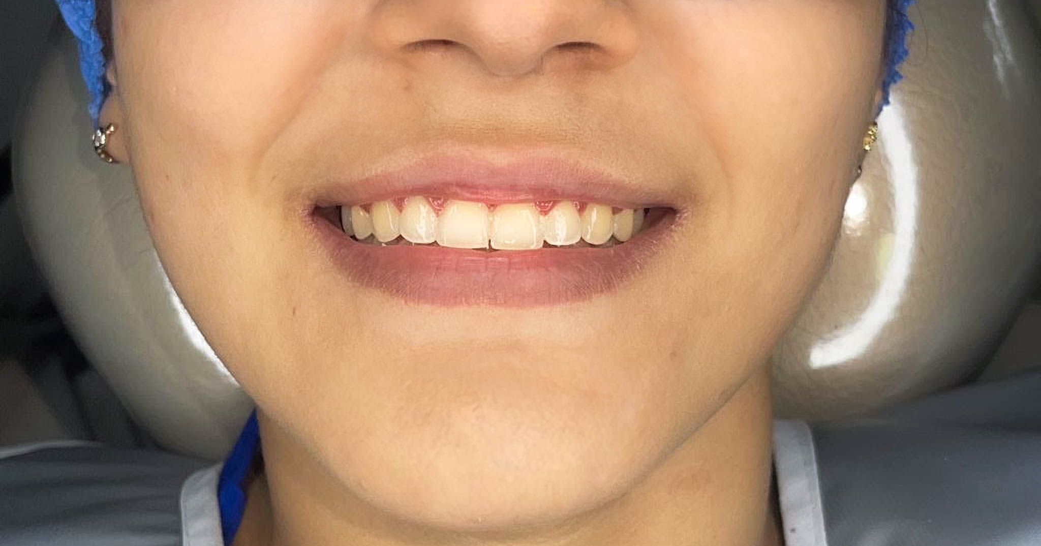 Resultados Paciente: Ortodoncia Funcional y Resinas de Alta Estética