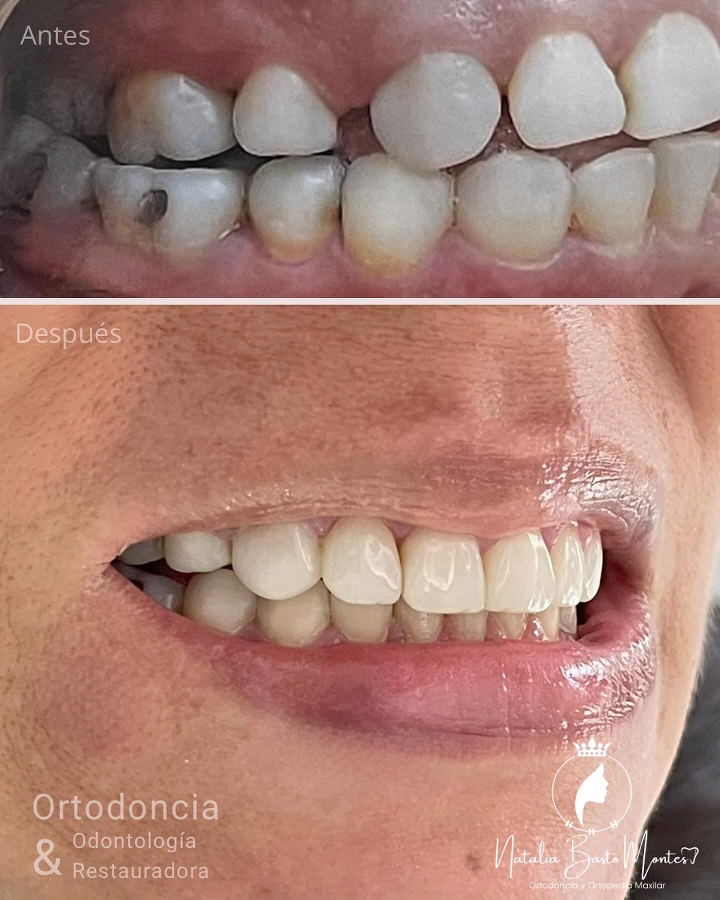 Sonrisa en Armonía: Ortodoncia + Bordes Incisales en Resina de Alta Estética