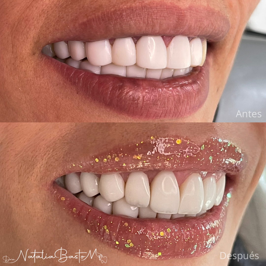 Mejoramos la sonrisa de nuestra paciente con resinas de alta estética dental