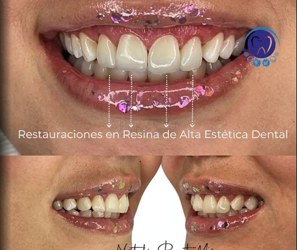 Última imagen de resinas