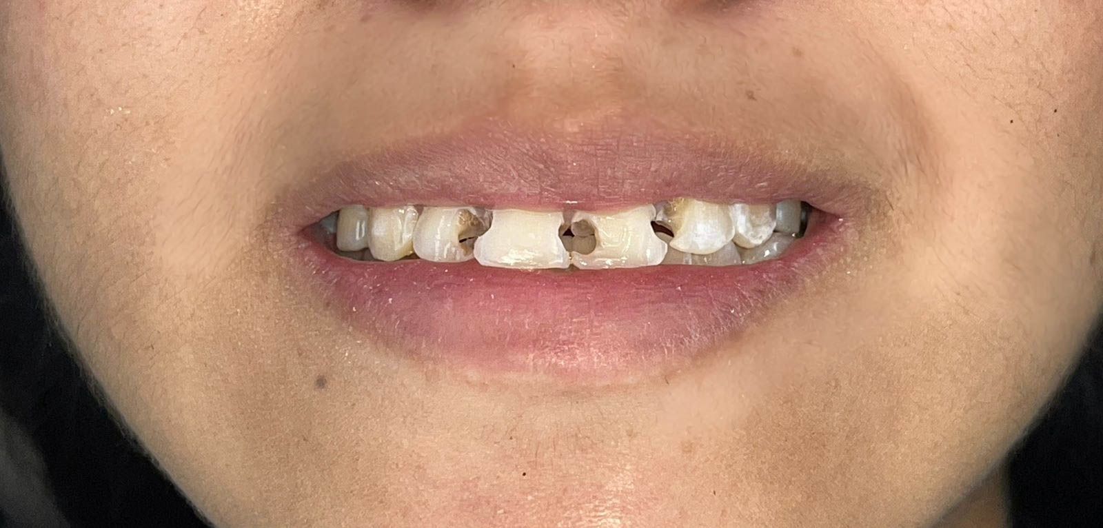 Restauraciones en Resina para una Sonrisa Natural