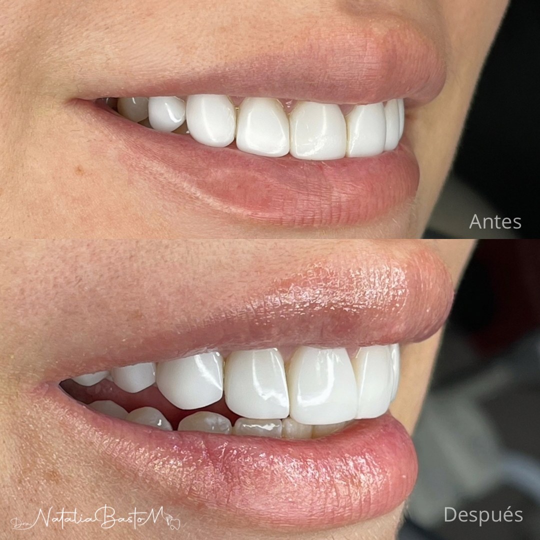 Renovación de Diseño de Sonrisa con Carillas en Resina: Un Caso de Éxito