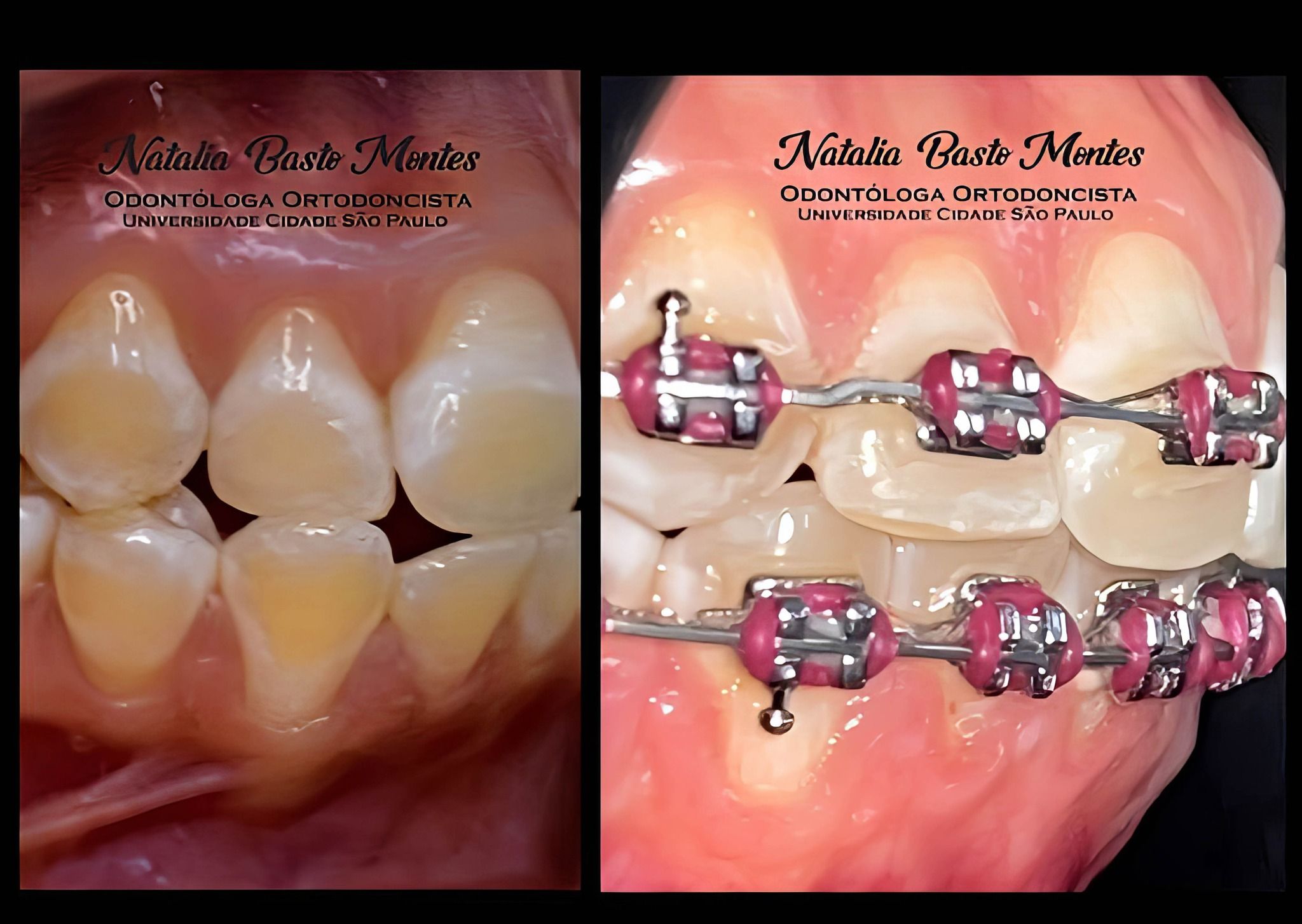 Corrigiendo Dientes inclinados hacia un lado mediante Ortodoncia