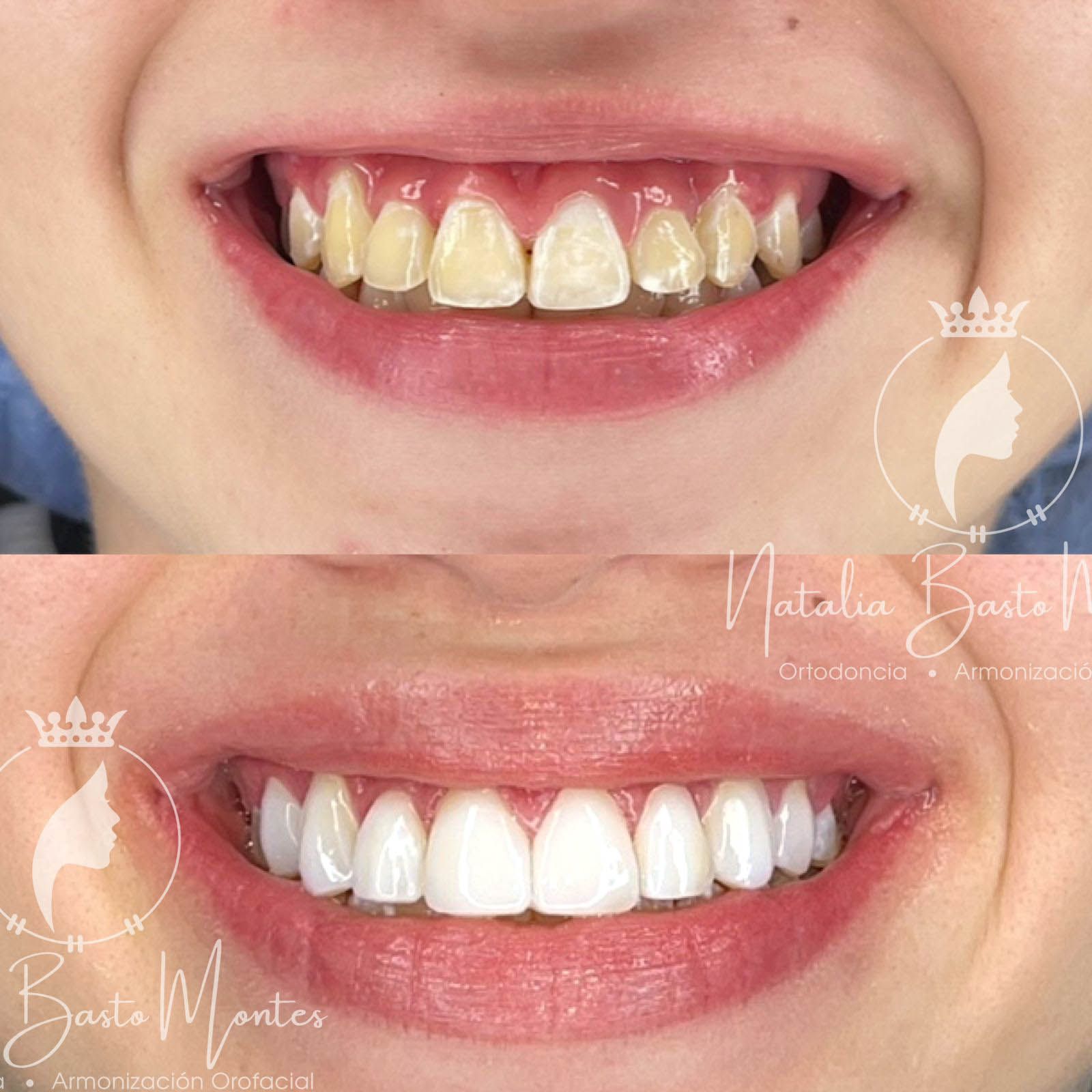 Resultados para una de nuestras pacientes: Ortodoncia y Estética Dental con Carillas de Resina