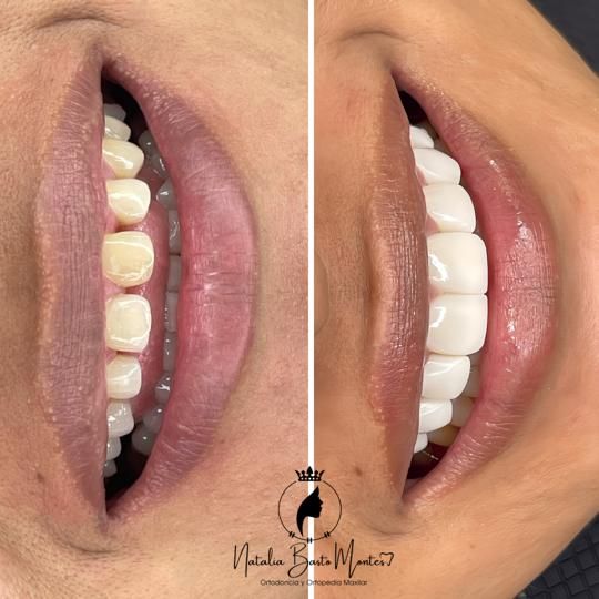 !Un Cambio de Sonrisa Sin Desgaste Dental!
