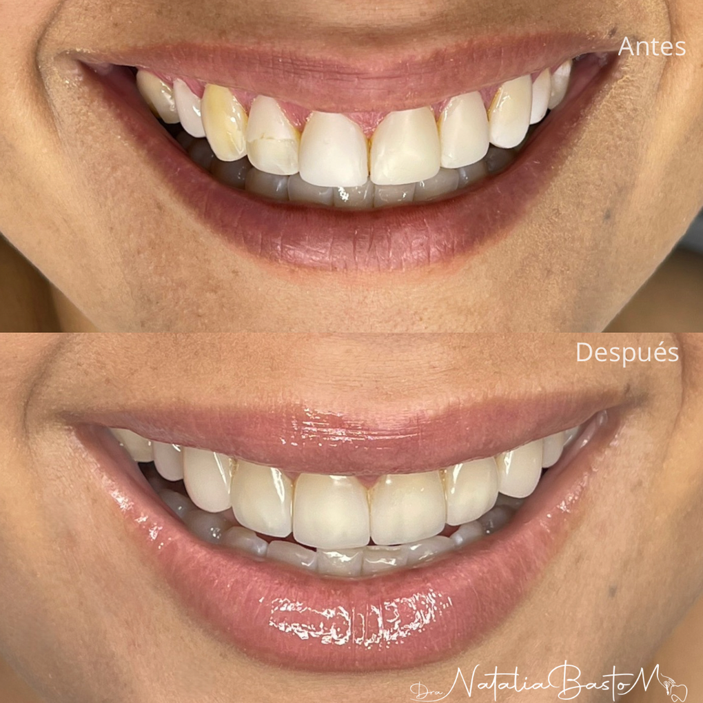 Prótesis dental de alto impacto