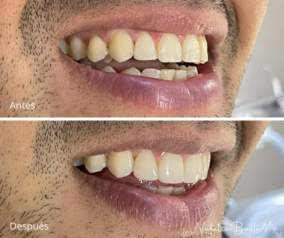 Restauración estética con resina: naturalidad y armonía en la sonrisa