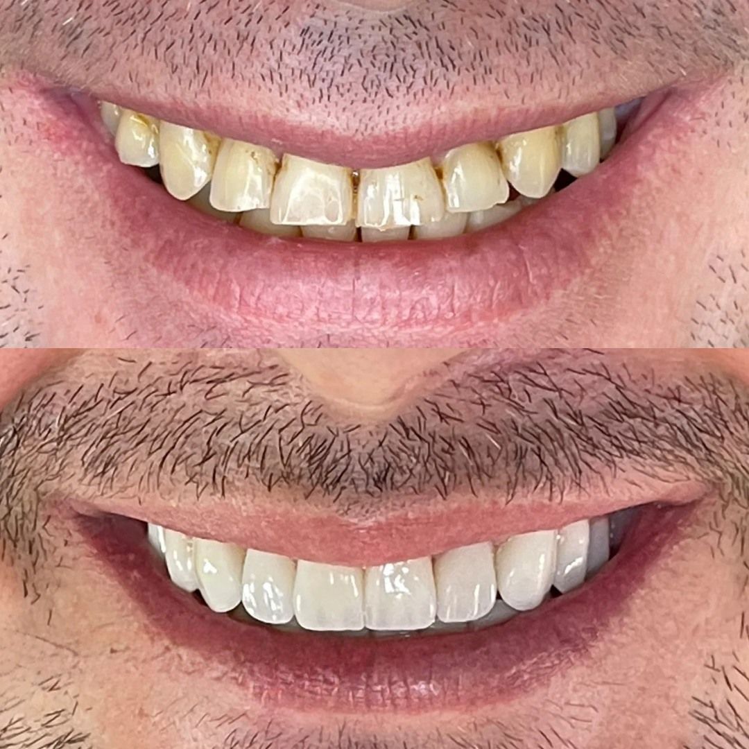 Un excelente cambio en Dientes Desalineados e inclinados en nuestro Paciente
