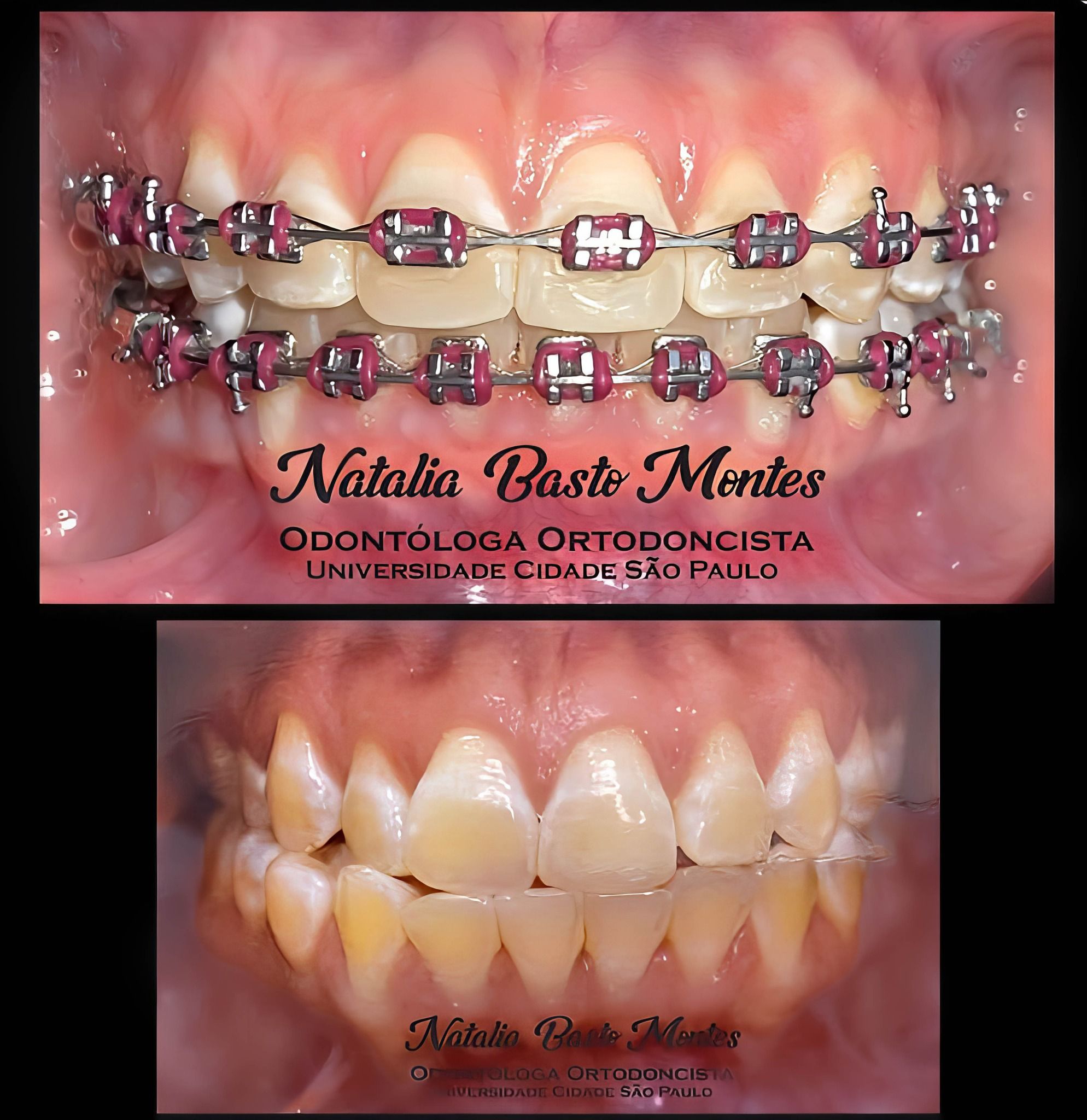 Corrigiendo Dientes inclinados hacia un lado mediante Ortodoncia