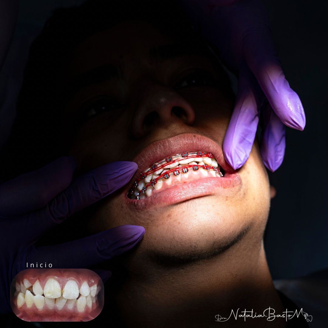  Caso de Éxito: Alineando un Diente Retenido, Produciendo una Sonrisa Brillante