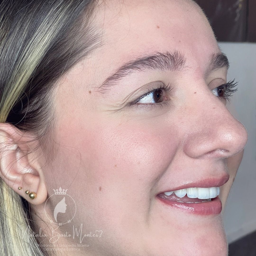 ¡Una sonrisa radiante con resinas de alta estética dental estratificadas!