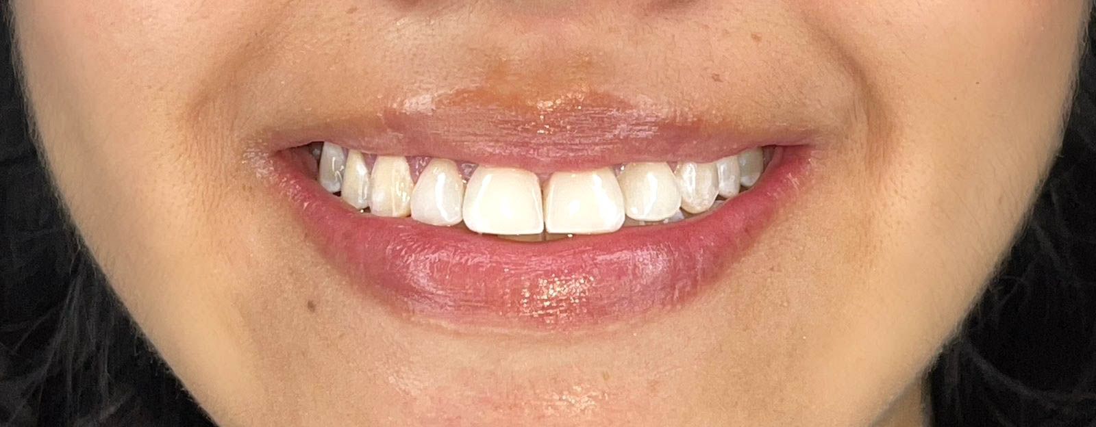 Restauraciones en Resina para una Sonrisa Natural