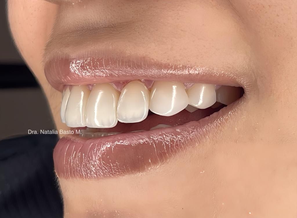 Resultados Paciente: Ortodoncia Funcional y Resinas de Alta Estética