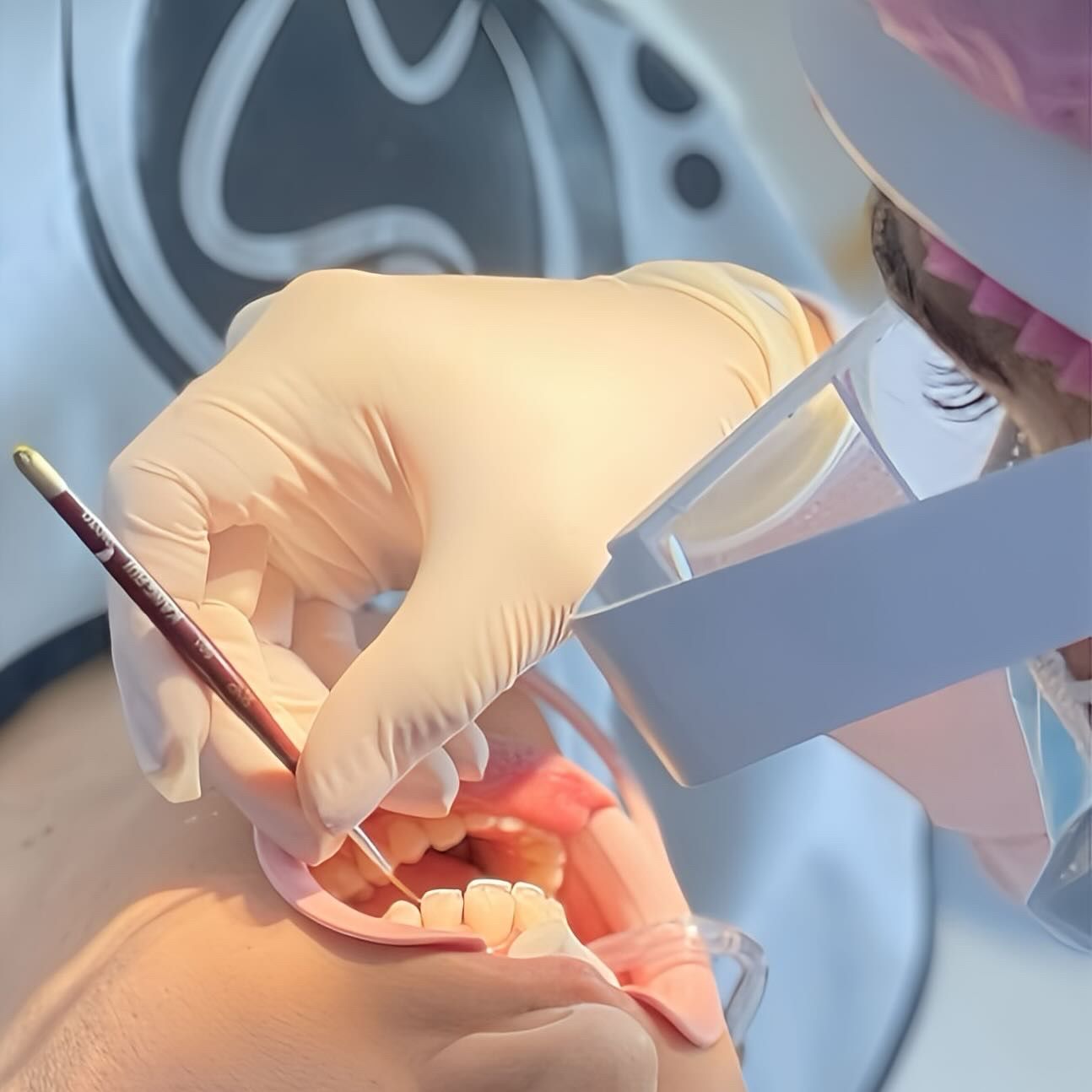 Caso de Éxito: Diseño de Sonrisa con Resinas Directas