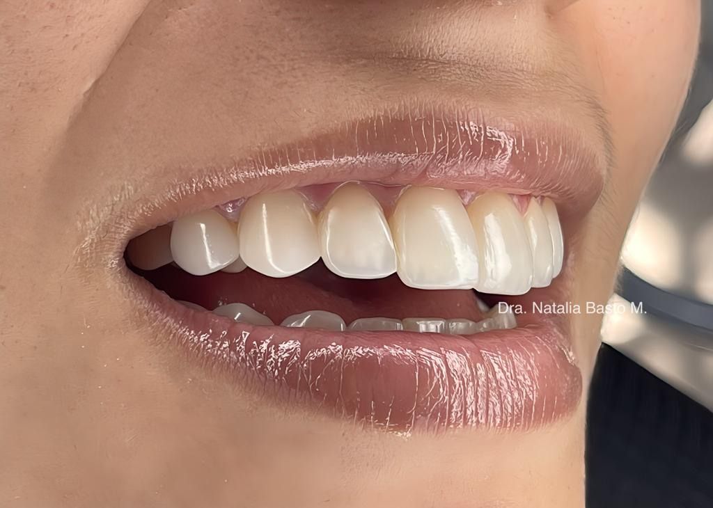 Resultados Paciente: Ortodoncia Funcional y Resinas de Alta Estética