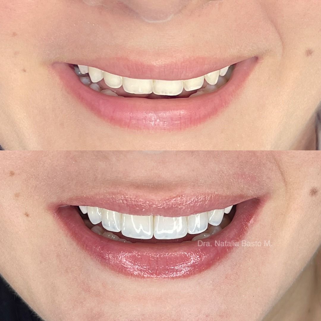 ¡Una sonrisa radiante con resinas de alta estética dental estratificadas!