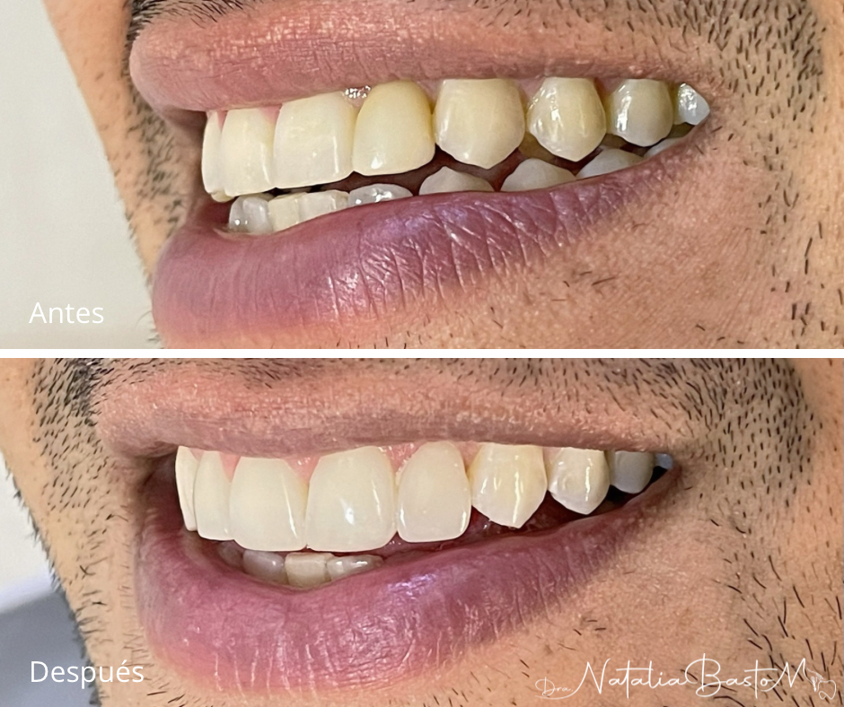 Restauración estética con resina: naturalidad y armonía en la sonrisa