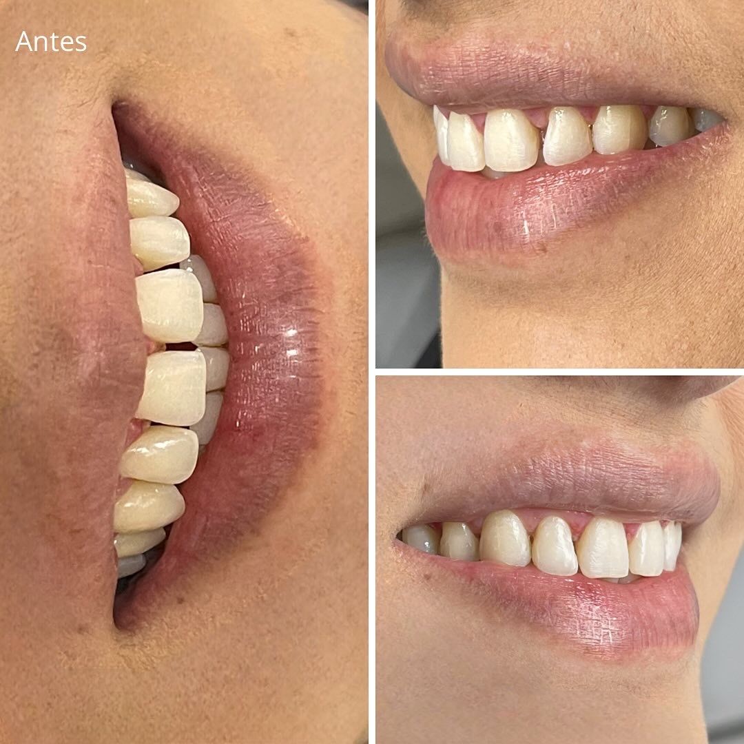 Caso de Éxito: Diseño de Sonrisa con Resinas Directas