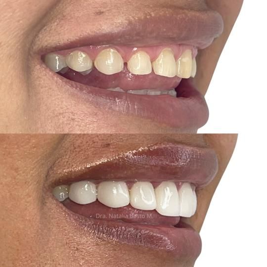 !Un Cambio de Sonrisa Sin Desgaste Dental!