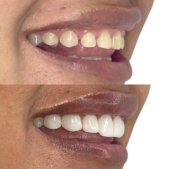 !Un Cambio de Sonrisa Sin Desgaste Dental!