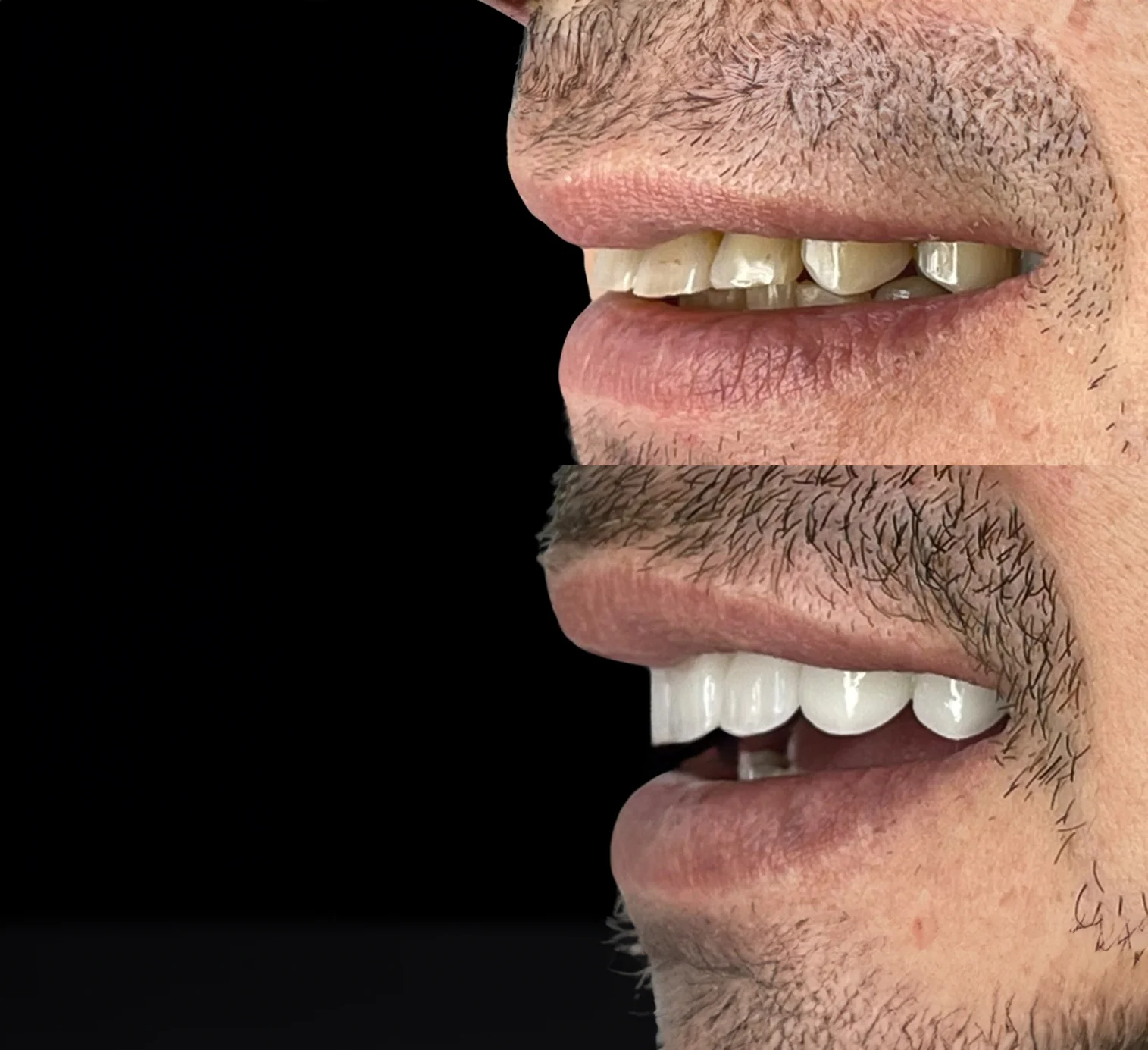 Un excelente cambio en Dientes Desalineados e inclinados en nuestro Paciente