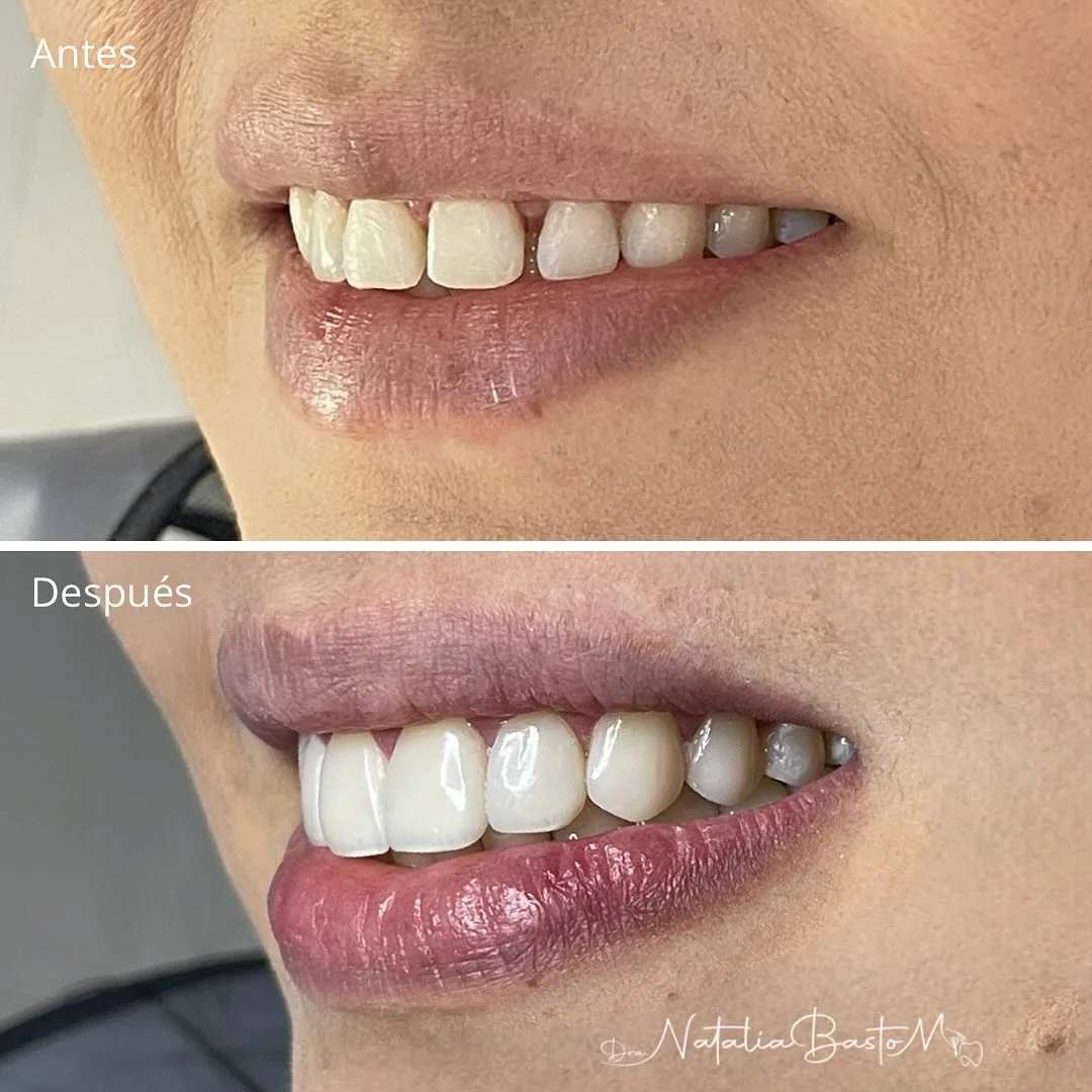 Caso de Éxito: Diseño de Sonrisa con Resinas Directas