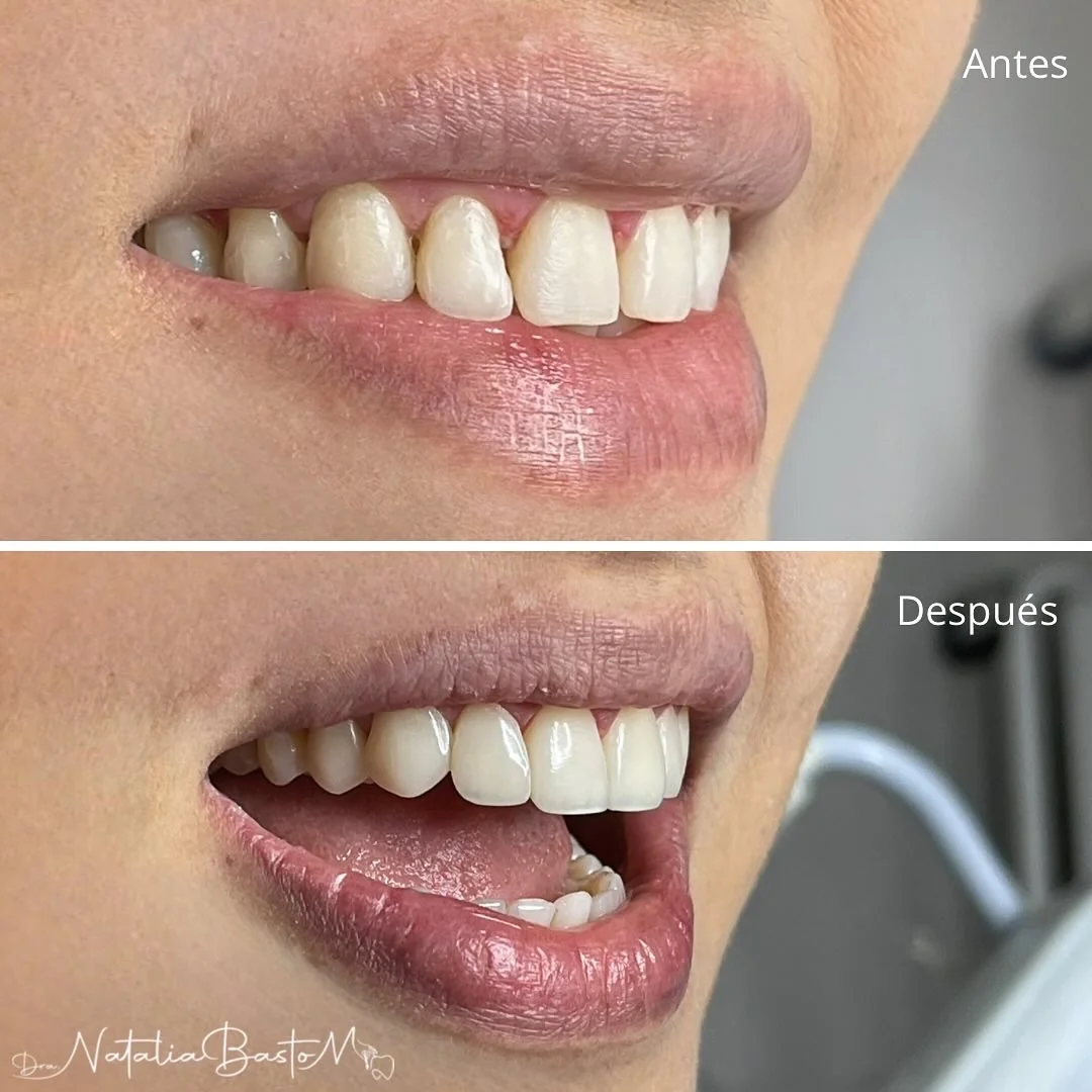 Caso de Éxito: Diseño de Sonrisa con Resinas Directas