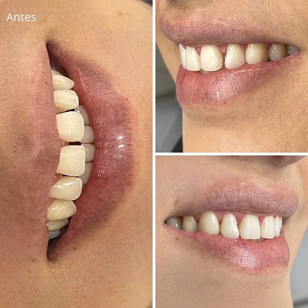 Caso de Éxito: Diseño de Sonrisa con Resinas Directas