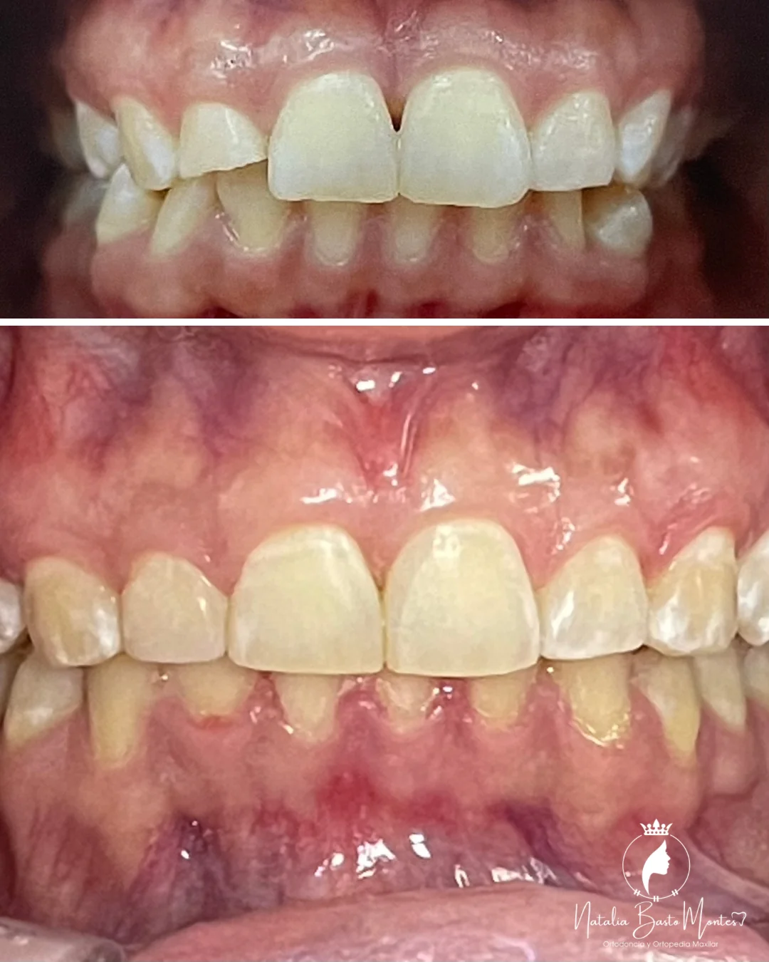 Ortodoncia de Brackets Metálicos con Resultados Estéticos y Funcionales