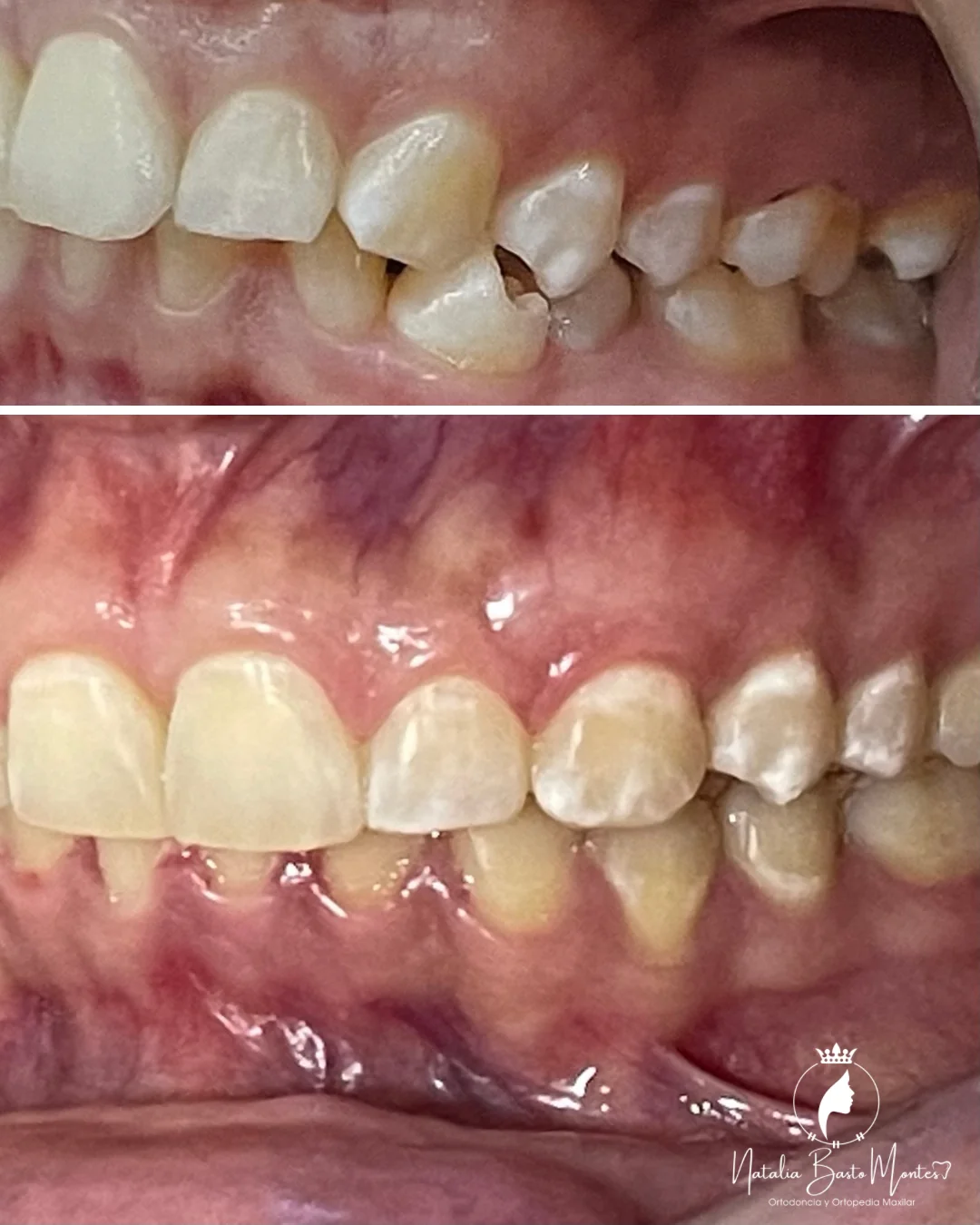 Ortodoncia de Brackets Metálicos con Resultados Estéticos y Funcionales
