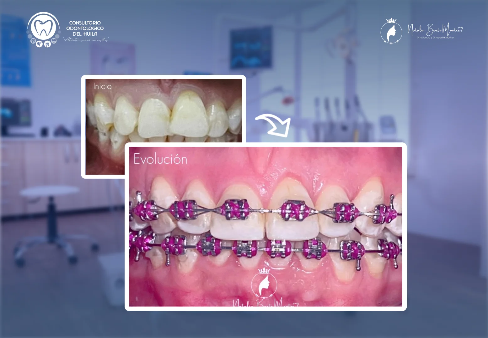 Evolución de Sonrisa: Tratamiento de Fluorosis y Ortodoncia en Proceso