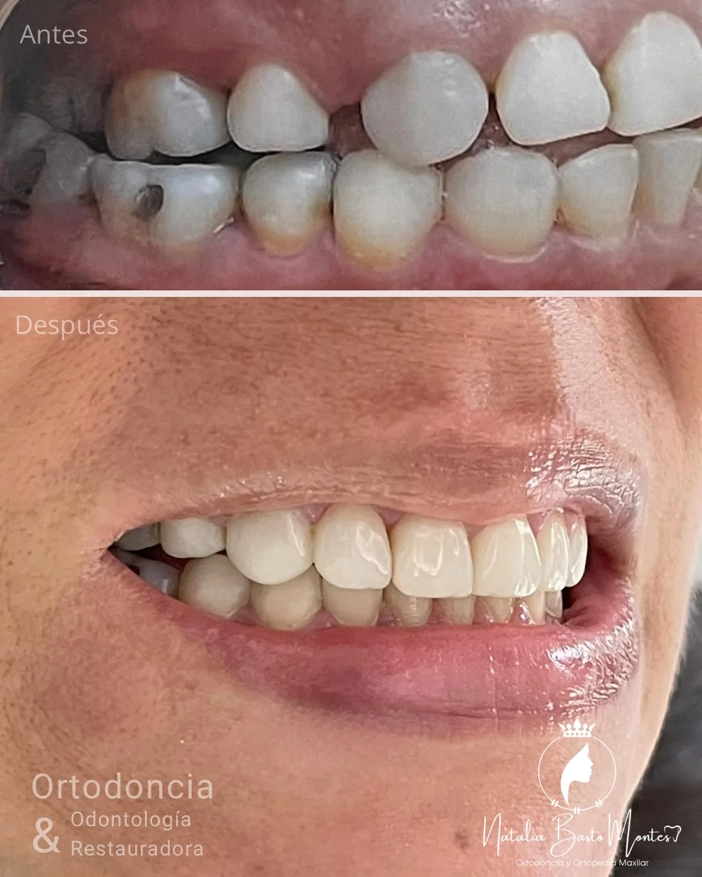 Sonrisa en Armonía: Ortodoncia + Bordes Incisales en Resina de Alta Estética