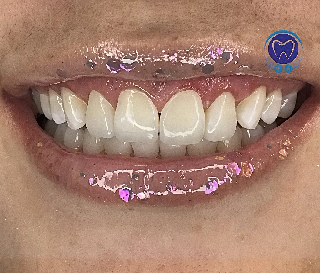 Rediseñamos su sonrisa con resinas… y el resultado fue espectacular