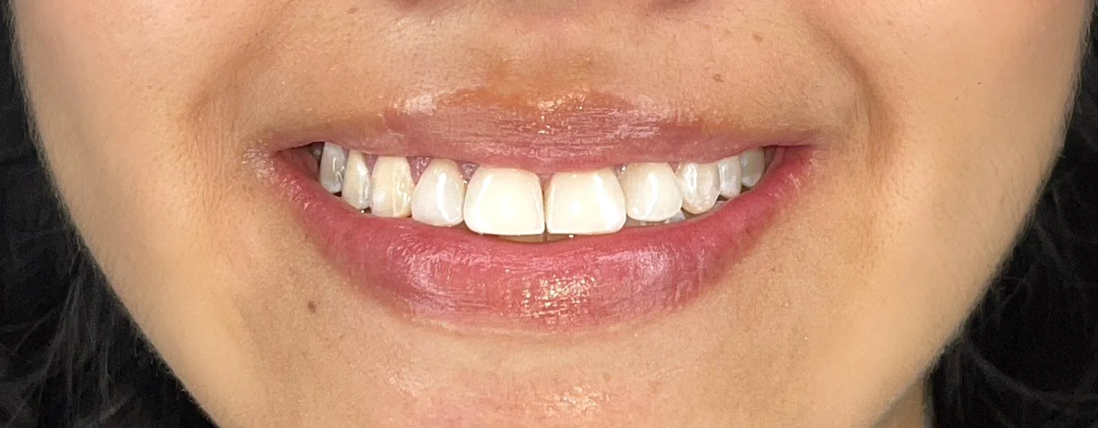 Restauraciones en Resina para una Sonrisa Natural