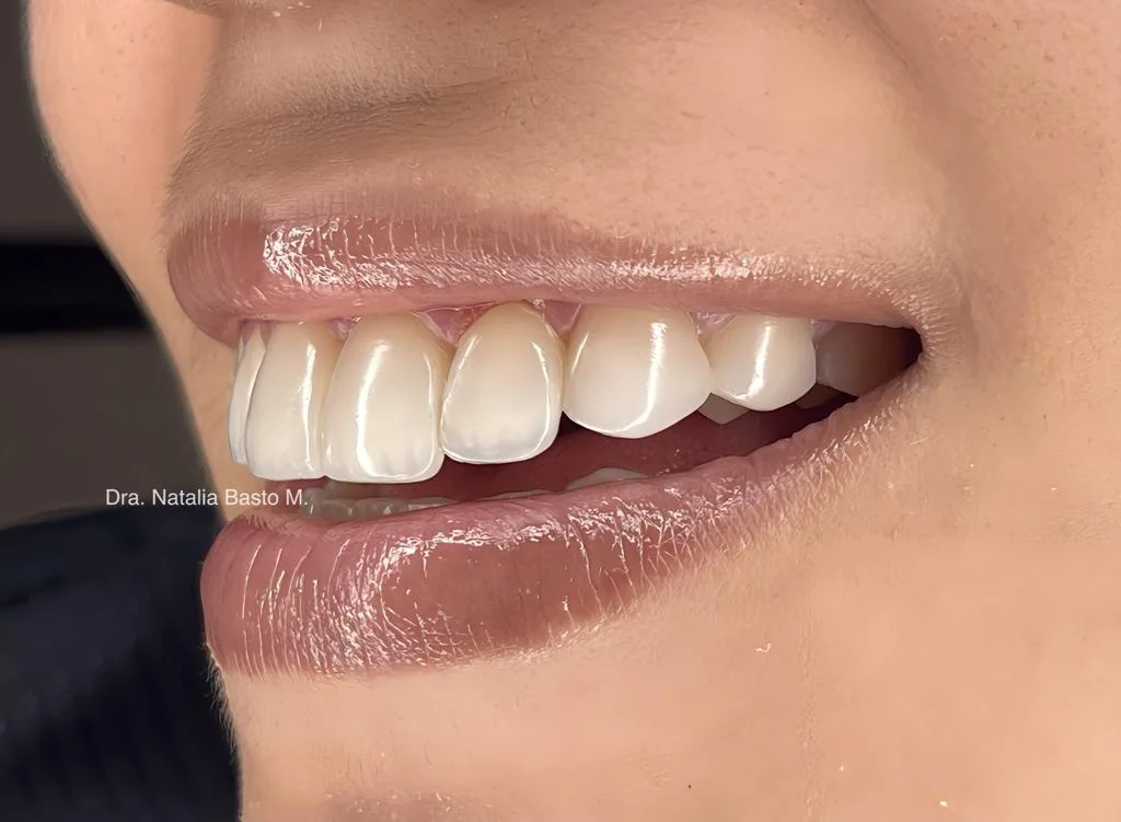 Resultados Paciente: Ortodoncia Funcional y Resinas de Alta Estética