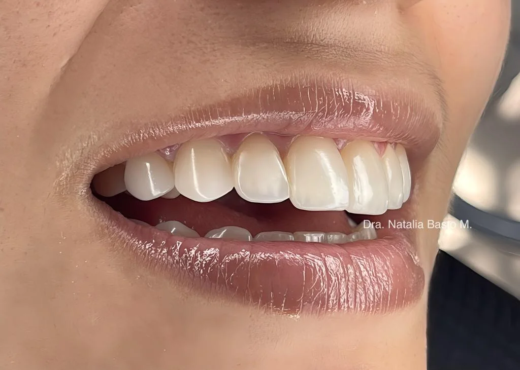 Resultados Paciente: Ortodoncia Funcional y Resinas de Alta Estética