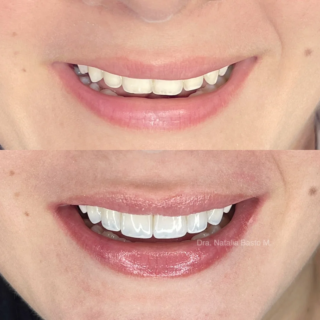 ¡Una sonrisa radiante con resinas de alta estética dental estratificadas!