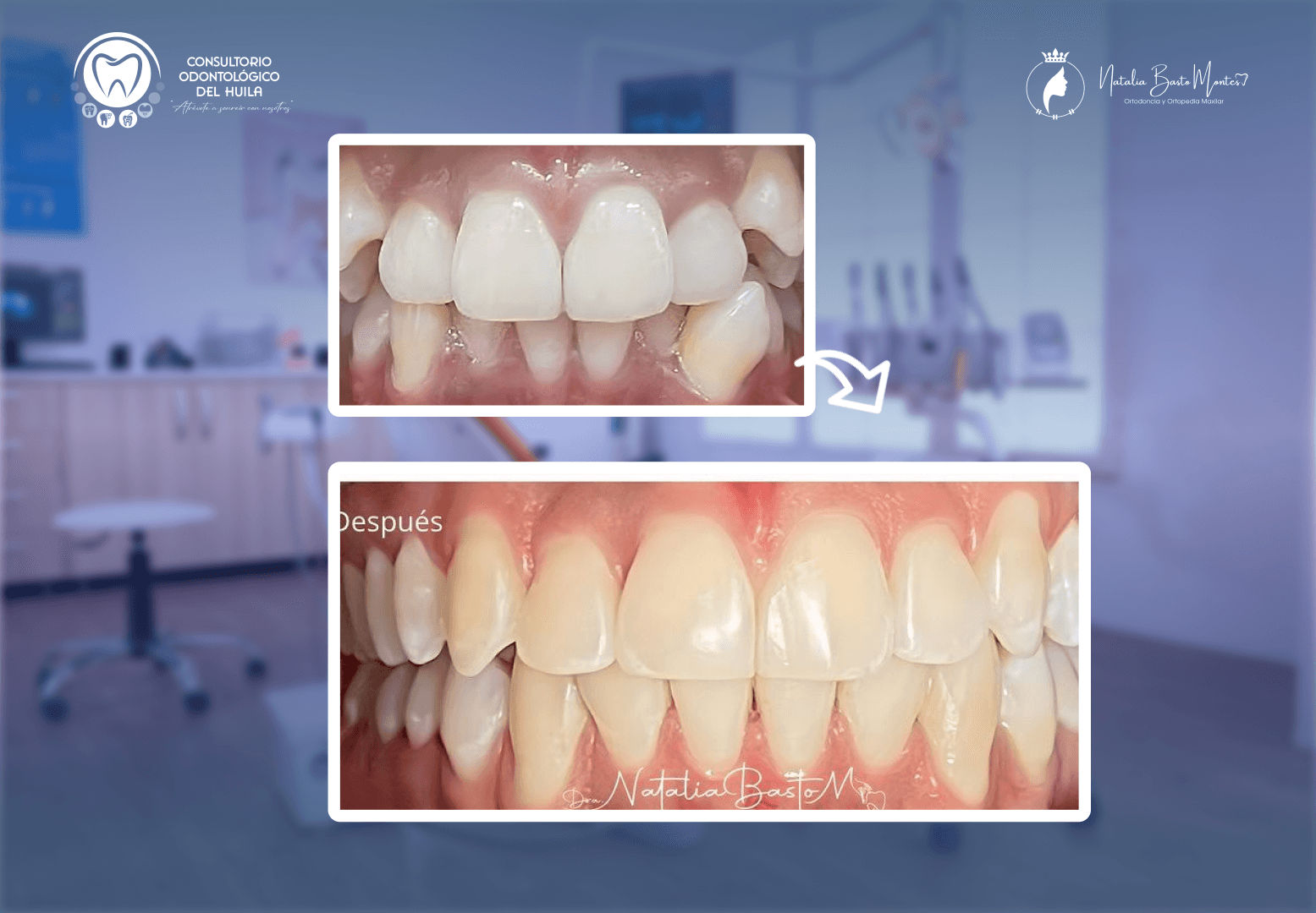 Una Sonrisa Transformada  mediante Brackets MBT: precisión y resultados